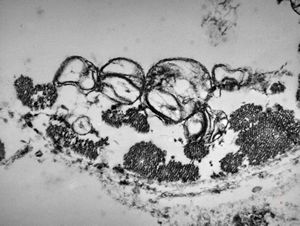 M, | newborn heart … mitochondrial cardiomyopathy … reduced mitochondrial cristae … autopsy sample M, | newborn heart … mitochondrial cardiomyopathy … reduced mitochondrial cristae … autopsy sample